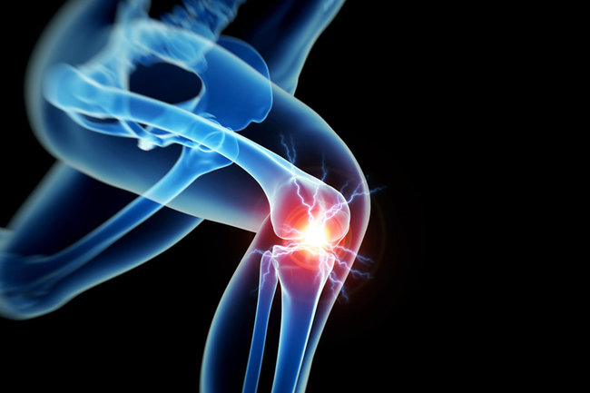 Artroza koljena: liječenje, uzroci, simptomi i tijek bolesti