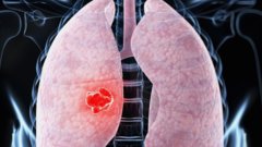 После COVID-19 легкие могут продолжать повреждаться из-за воспалительных процессов