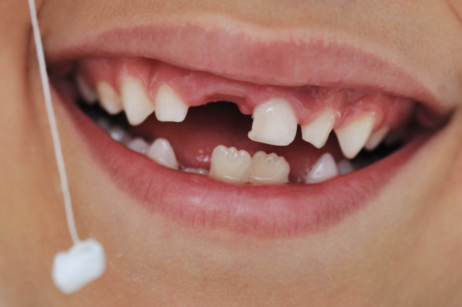 Кривые зубы у взрослого человека. Идеальные зубы. Пустые зубы. Пустые зубы. Пустые зубы.