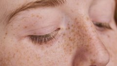 Дерматолог рассказала о связи веснушек и риска рака