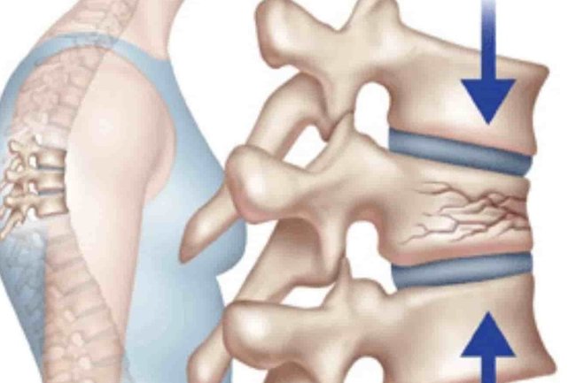 Ученые превращают жировую ткань в костную, чтобы лечить переломы позвоночника