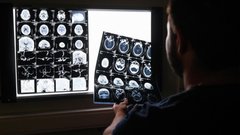 Иллариошкин: непрерывная оценка когнитивных функций снизит риск деменции на 50%
