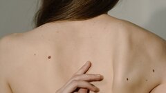 Британка умерла в 30 лет после борьбы с меланомой