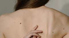 Асимметричные родинки могут быть признаком рака кожи