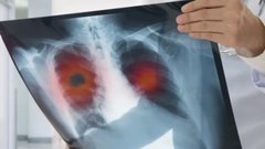 Советы профессора Айсанова для россиян с опасной легочной болезнью