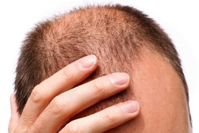 Выпадают волосы у мужчин: что делать против облысения на голове?