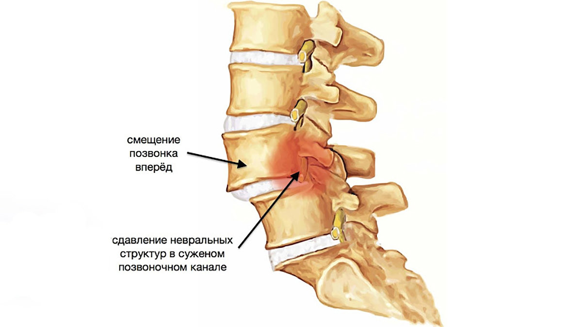 Спондилоартроз пояснично-крестцового отдела позвоночника: признаки
