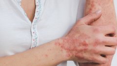 Доктор Бурлаков: алкоголизм увеличивает риск появления псориаза