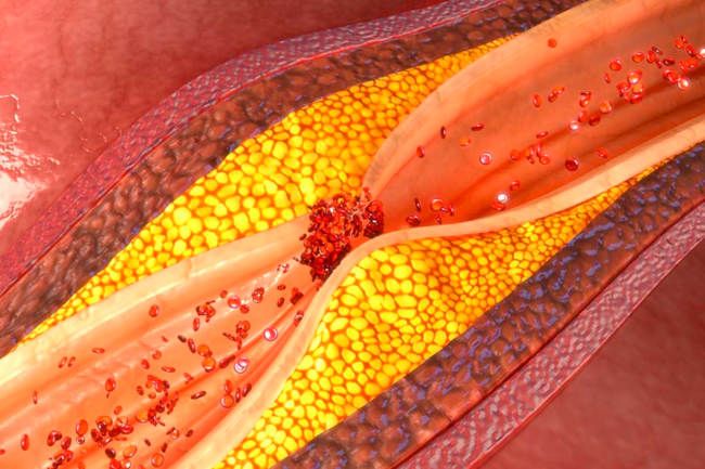 Холестерин