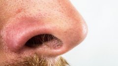 На каких участках тела чаще возникает рак?