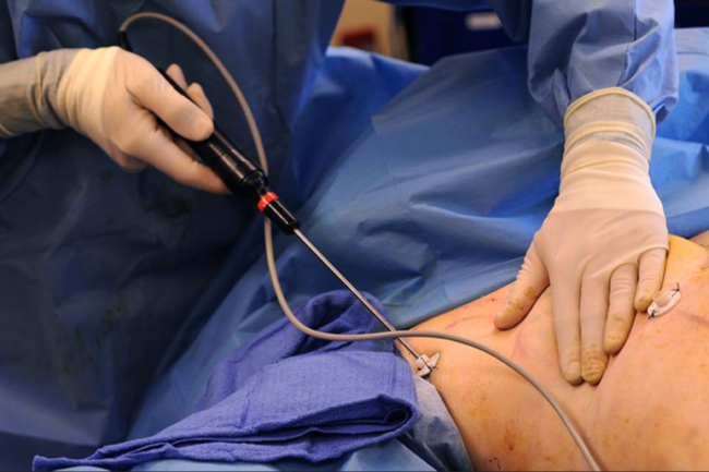 Вакуумная липосакция