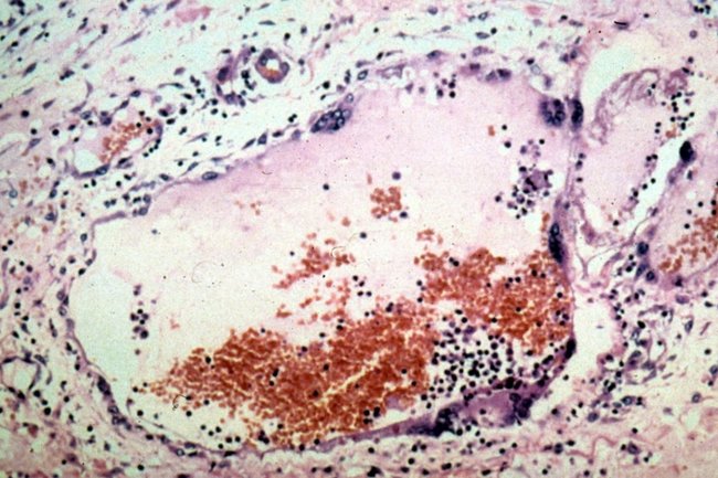 Вирус Нипах