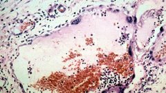 ВОЗ оценила смертность от вируса Нипах в 40-75%