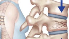 В России разработан метод лечения травм спинного мозга